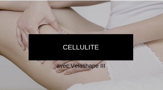 Cellulite // Velashape III