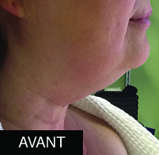 Venus Freeze Plus (Avant)